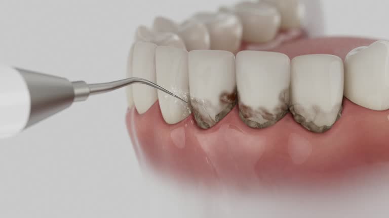 Reliable Tooth Extraction contractor in Harrison County County, IN by Dentist Open Now